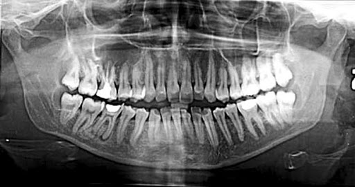 LA RADIOPROTEZIONE CONTRO LE RADIAZIONI IONIZZANTI: APPLICAZIONI CLINICHE IN ODONTOIATRIA